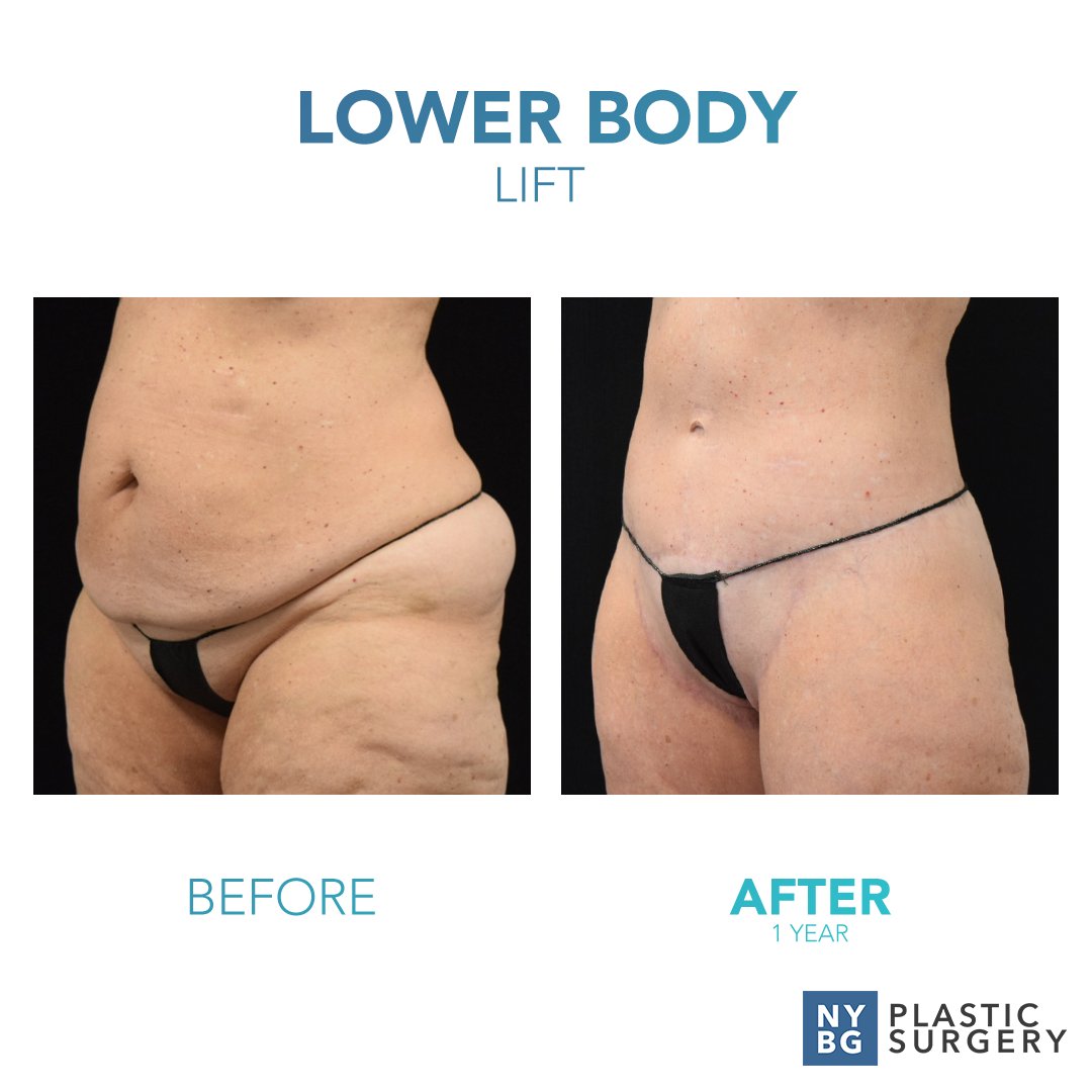 DrKevinSmall's tweet photo. A lower body lift can improve the shape and tone of the body - just in time for summer! 

Visit us online at: https://t.co/vnpYP39GID

#NYBGPlasticSurgery #PlasticSurgery #PlasticSurgeryAfterWeightLoss #Success #Inspiration #Motivation #LowerBodyLift #LBL https://t.co/OV2YOOqxzO