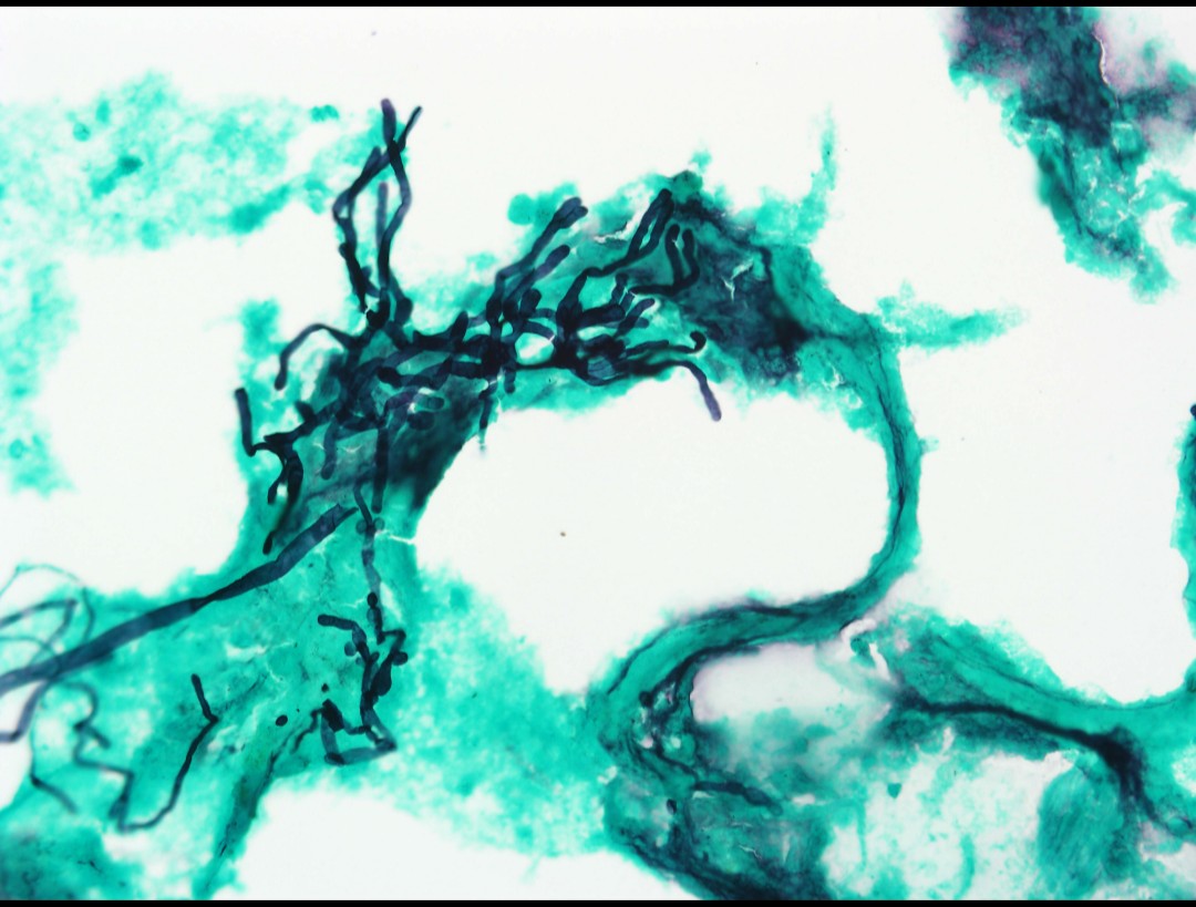 MansoAso's tweet photo. M, 65 years. BAL, Aspergillosis, Grocott methenamine silver. ๐ฌ๐ฌ๐๐ #cytopath #FridayFunday #microbi #summerpath. When I look at this, I just think of the sea... I need holidays๐๏ธ๐๏ธ๐ฅ๏ธโด๏ธ
@tlabiano @SECitologia @mdlozanoe @duckhuca https://t.co/oyxk9AFvv7