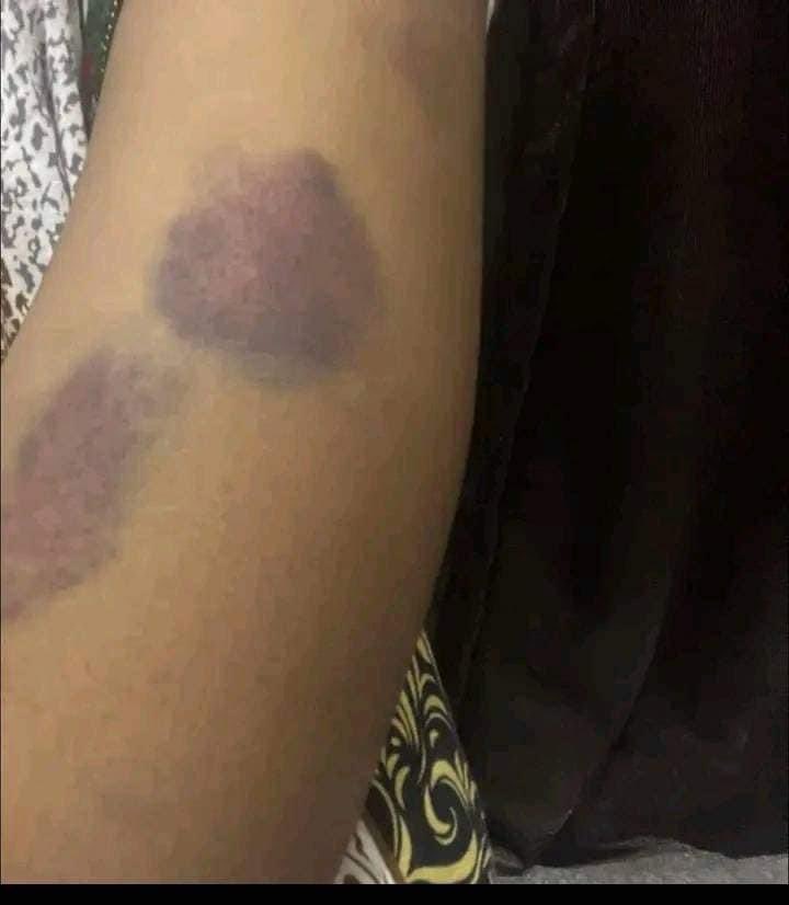 salma1siddig's tweet photo. إنتهاكات جسدية وتعذيب بقسوة تعرضت له الثائرة غفران من قبل مليشيات البرهان في مليونية 30 يونيو بالأمس.

محتوى حساس https://t.co/yLCWZwS7o3