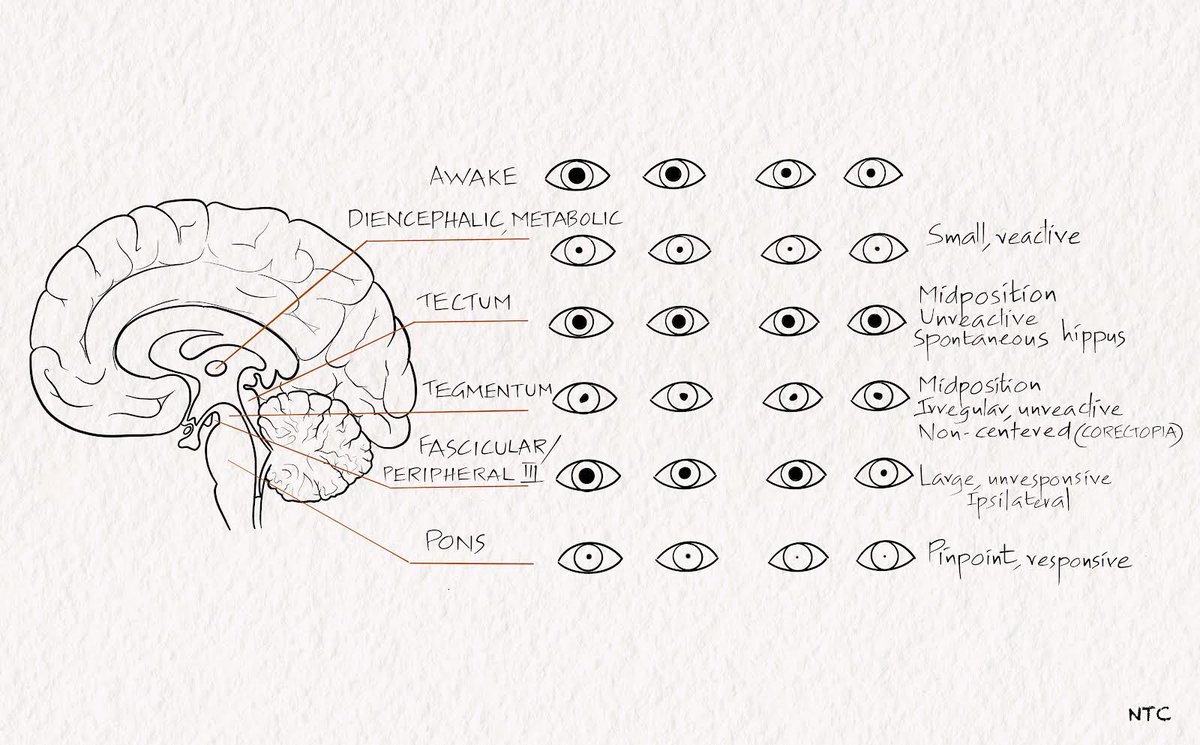 neuroteaching's tweet image. 🚨🚨📣📣New #Episode Alert 🚨 Approach to a #comatose patient @neurologywithkd podcast. Should be useful for #medicalstudents, #medicineresidents #neurology and #emergencymedicine residents.
🎧👂 apple.co/3ujesYR 🎙    #MedEd #NeuroTwitter #MedTwitter #medicalpodcast