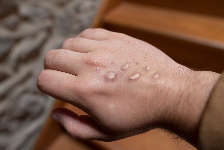 What exactly is monkeypox? Our disease expert, Dr. Beth Thielen, talks about what to look for and how to prevent it ➡️: bit.ly/3NBfiXT.