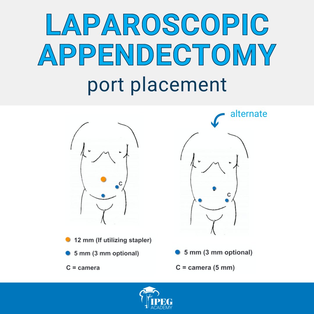 IPEGSurgery's tweet photo. Here is the port placement &amp; alternate port placement for a #LaparoscopicAppendectomy! Did you know that all of our #IPEGAcademy instructional videos include diagrams for the port placement?

Watch the full video on the @StayCurrentMD app!

#some4pedsurg #pediatricsurgery https://t.co/iGjX4nvI4f