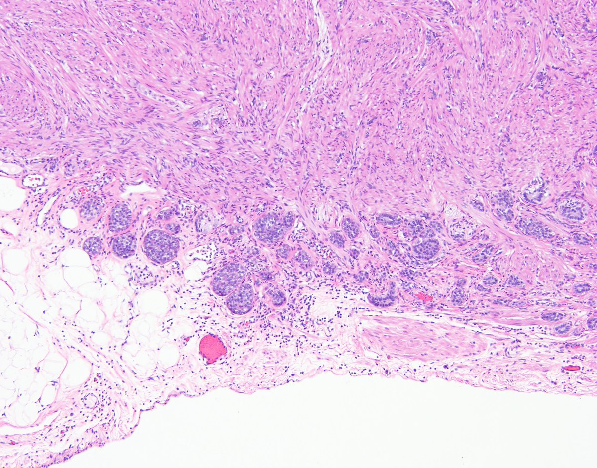 DrEstherAdler's tweet photo. Pathology residents, why do we always submit the appendiceal tip? Incidental finding in grossly normal appendix removed as part of GYN staging procedure. 5mm greatest dimension. What's the diagnosis and stage (based on these images)? #Pathology #Meded @NYUGSOMpathres @nyugrossman https://t.co/kwWrxnyMKN