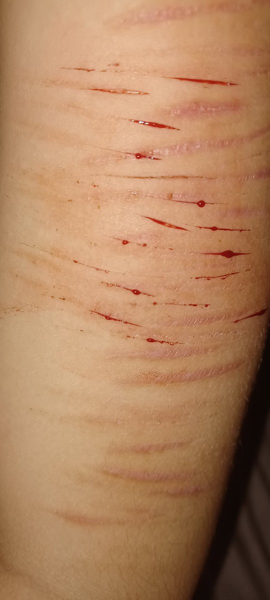 LEE90854662's tweet photo. Tw: self harm, shtwt, styro, styrotwt, cuts, blood
.
.
.
Some small styros, im so bored with life. I always try my best to help everyone except myself. https://t.co/ZH4w2yoSGK