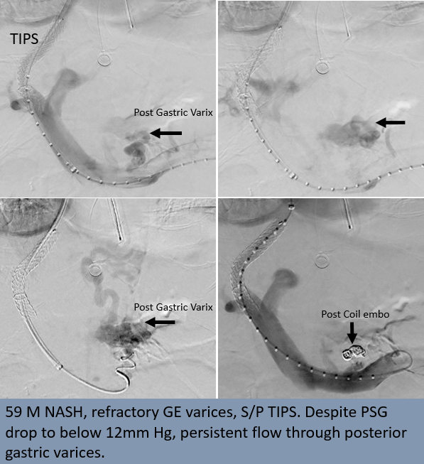Rakesh Varma (@rakeshkvarma) on Twitter photo Clinical Pearls in IR 18:
<a href="/uab_ir/">UAB IR</a> Combination techniques (combining decompression with embolization) are considered for effective control of gastric and ectopic varices (varices farther away from liver)
<a href="/SIRspecialists/">Society of Interventional Radiology</a> <a href="/SIRRFS/">SIR RFS</a> <a href="/SIR_ECS/">SIR ECS</a> <a href="/ISVIRIndia/">ISVIR India</a> #irad #Cirrhosis Clinical Pearls in IR 18:
<a href="/uab_ir/">UAB IR</a> Combination techniques (combining decompression with embolization) are considered for effective control of gastric and ectopic varices (varices farther away from liver)
<a href="/SIRspecialists/">Society of Interventional Radiology</a> <a href="/SIRRFS/">SIR RFS</a> <a href="/SIR_ECS/">SIR ECS</a> <a href="/ISVIRIndia/">ISVIR India</a> #irad #Cirrhosis