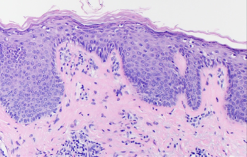 Christine J. Ko, MD (@christinejkomd) on Twitter photo What's your #dermatology #diagnosis? The patient responded to ustekinumab... ja.ma/3Ahc6gT via <a href="/JAMADerm/">JAMA Dermatology</a> part of <a href="/JAMANetwork/">JAMA Network</a> #dermpath #dermtwitter #pathtwitter What's your #dermatology #diagnosis? The patient responded to ustekinumab... ja.ma/3Ahc6gT via <a href="/JAMADerm/">JAMA Dermatology</a> part of <a href="/JAMANetwork/">JAMA Network</a> #dermpath #dermtwitter #pathtwitter
