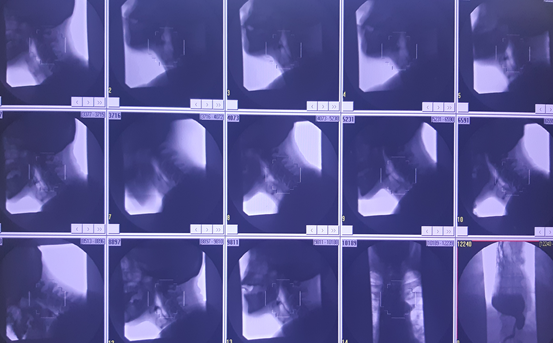 Michelle Hayes (@michellehayeslt) on Twitter photo Currently doing data collection to determine dysphagia post oesophagectomy - very fortunate to work and research with these patients <a href="/stjamesdublin/">St James's Hospital</a> #VFU #ICUSLT #cancersurgery #oesophagectomy
<a href="/JulieRegan_/">Julie Regan</a> <a href="/WalsheMargaret/">Margaret Walshe</a> <a href="/AnnaGillman/">Anna Gillman</a> <a href="/ClaireDonohoe6/">Claire Donohoe</a> <a href="/ISDE_net/">ISDE.net</a> <a href="/CancerInstIRE/">Trinity St James's Cancer Institute</a> Currently doing data collection to determine dysphagia post oesophagectomy - very fortunate to work and research with these patients <a href="/stjamesdublin/">St James's Hospital</a> #VFU #ICUSLT #cancersurgery #oesophagectomy
<a href="/JulieRegan_/">Julie Regan</a> <a href="/WalsheMargaret/">Margaret Walshe</a> <a href="/AnnaGillman/">Anna Gillman</a> <a href="/ClaireDonohoe6/">Claire Donohoe</a> <a href="/ISDE_net/">ISDE.net</a> <a href="/CancerInstIRE/">Trinity St James's Cancer Institute</a>