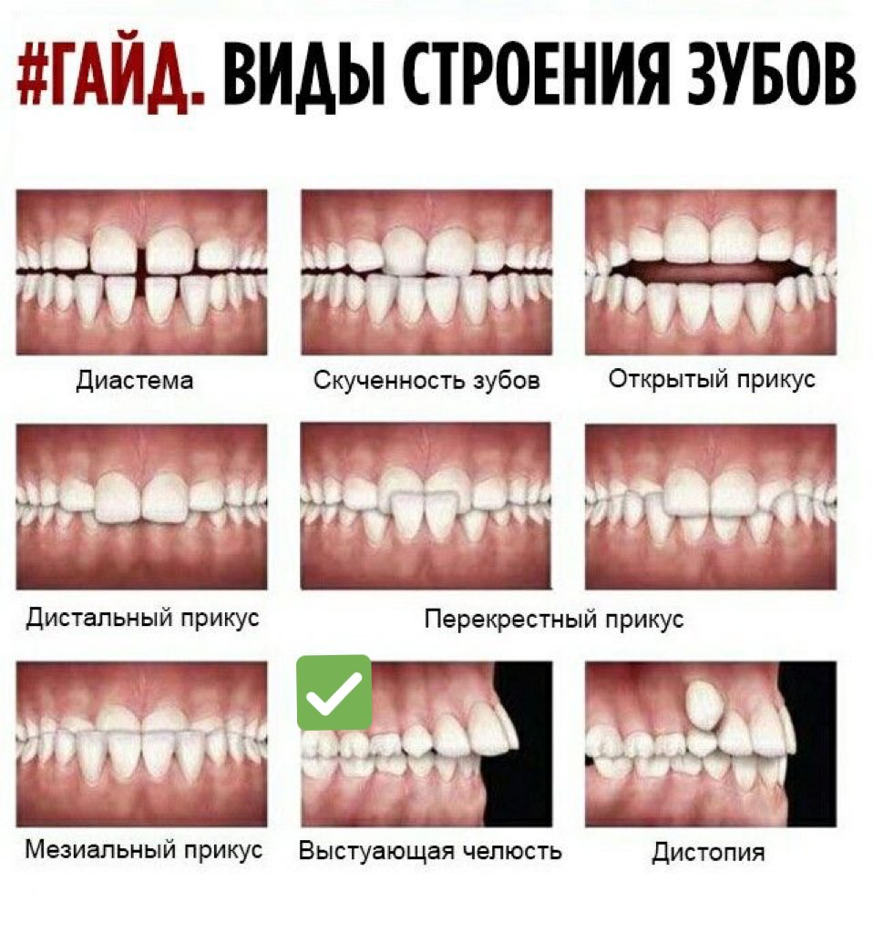 Аномалии прикуса II степени