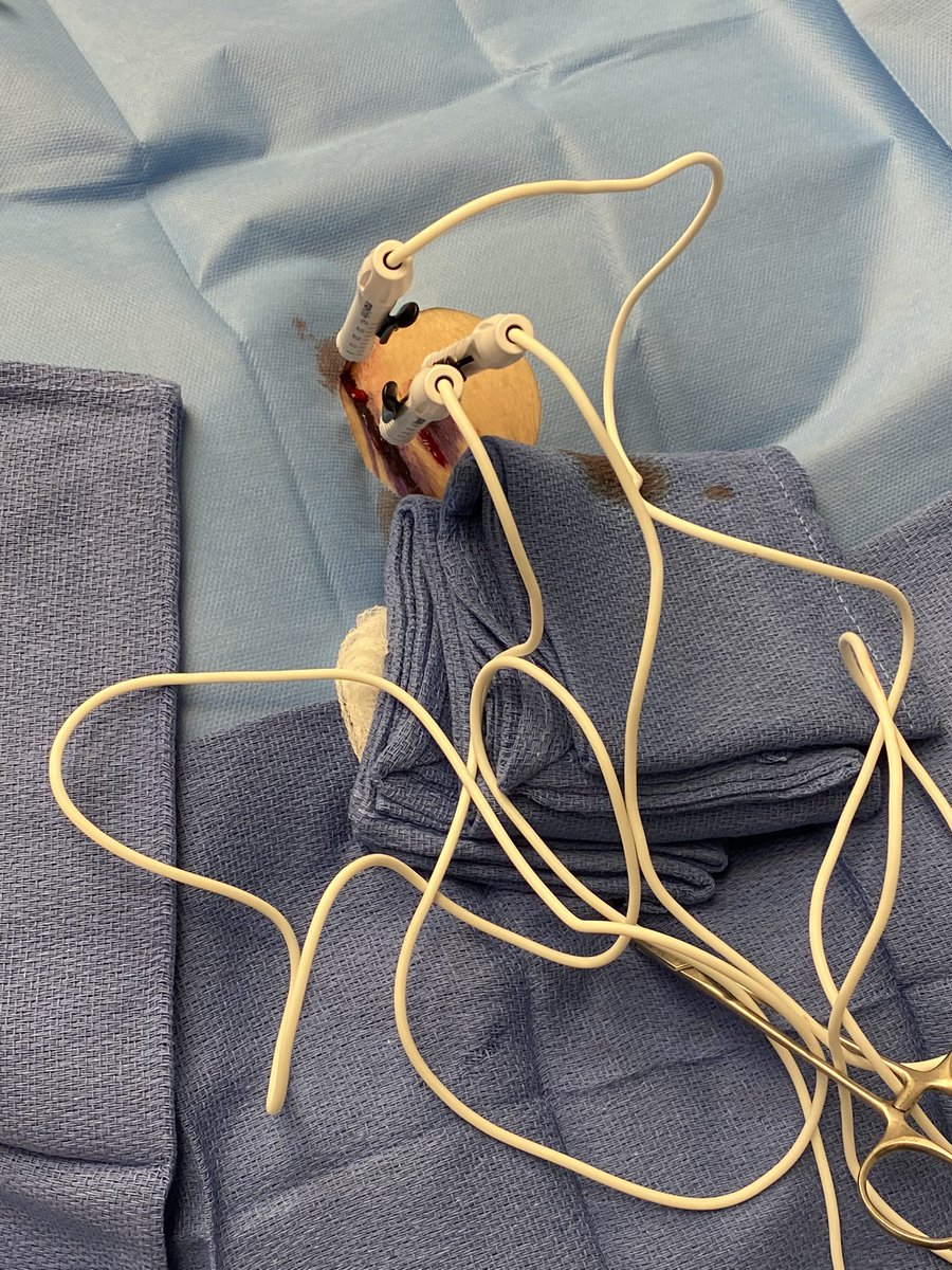 CharlesLugo007's tweet photo. Biopsy proven focal cholangiocarcinoma. Percutaneous IRE performed. @SIRspecialists @RajNarayanan67 @StonyBrookMed @KutsenkoMD @KiyonTavakolian @docTPlive @schiro_md @DrBTKatzen @DoctorCliffyy #Cancer #oncology https://t.co/SIsD5yiO43