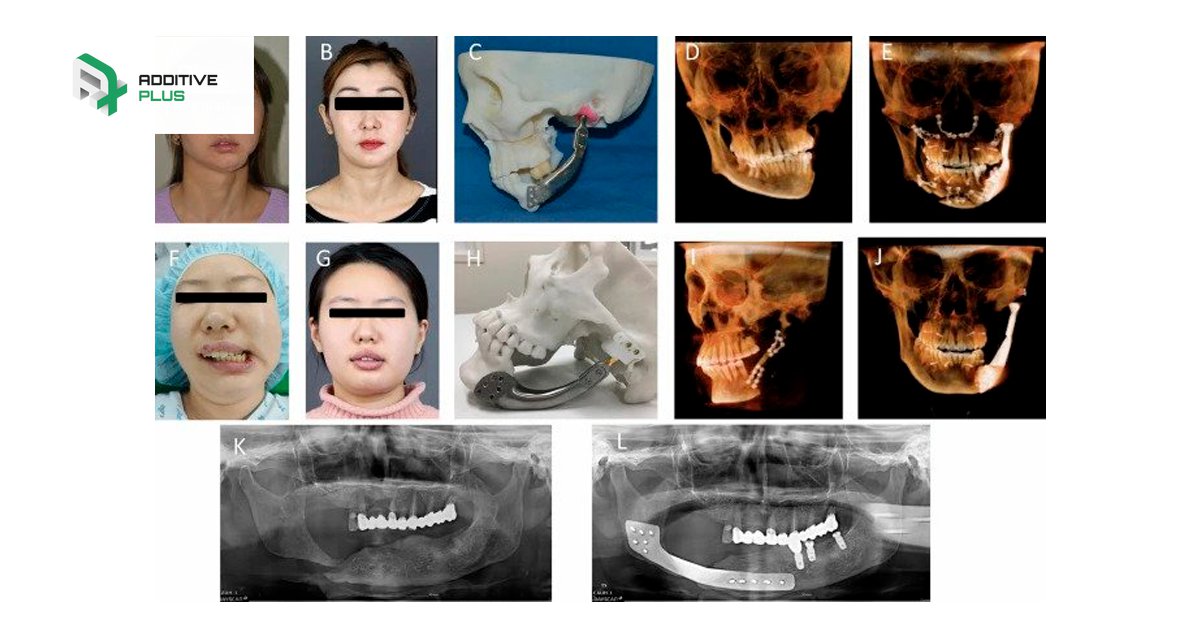 PlusAdditive's tweet image. NEW STUDY ASSESSES EFFECTIVENESS OF 3D PRINTED TITANIUM IMPLANTS ON BONE GROWTH

A group of researchers from Korean hospitals have carried out a retrospective study to verify the effectiveness and safety of patient-specific 3D printed titanium implants… t2p.pw/3cnMRr95eh