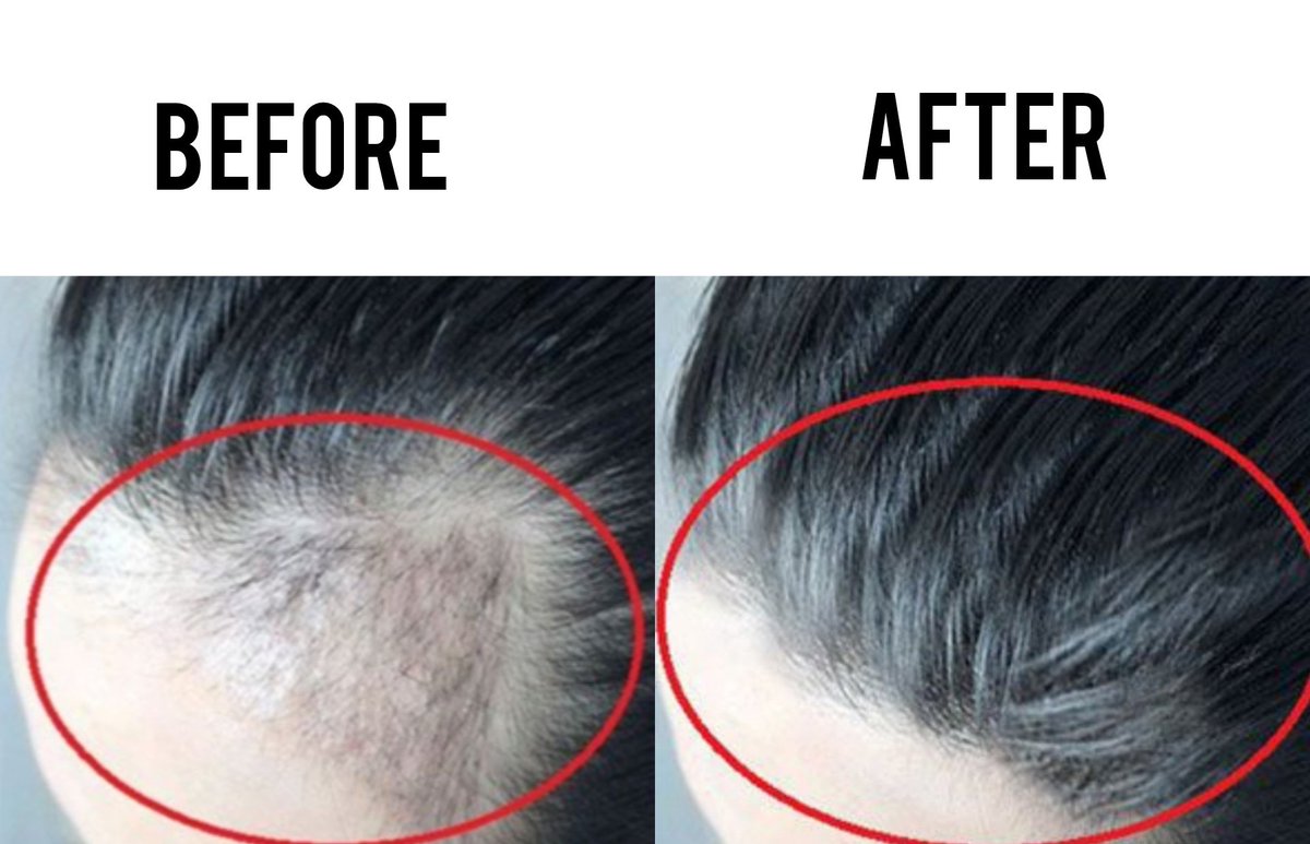 berburushopee's tweet photo. Kumpulan produk penumbuh rambut &amp; perawatan rambut rontok

- A thread - https://t.co/haAHH6zd4C