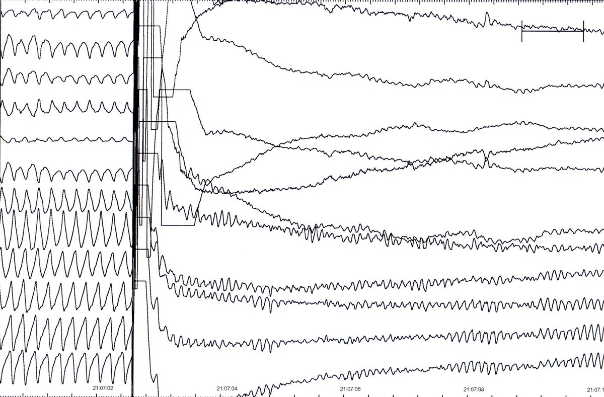 Arritmias H. Ramón y Cajal, Madrid. (@arritmias_hrc) on Twitter photo ECG for non-cardiologist: iatrogenic ventricular fibrillation caused by not synchronized cardioversion. In AF or Vent Tachy we must synchronize DC shock with QRS. Shocks during ST interval may lead to VF #Epeeps <a href="/ecgrhythms/">Arnel Carmona</a> <a href="/EF_Cardiaca/">EfectoElectrotónico</a> Do not sync to shock VF! ECG for non-cardiologist: iatrogenic ventricular fibrillation caused by not synchronized cardioversion. In AF or Vent Tachy we must synchronize DC shock with QRS. Shocks during ST interval may lead to VF #Epeeps <a href="/ecgrhythms/">Arnel Carmona</a> <a href="/EF_Cardiaca/">EfectoElectrotónico</a> Do not sync to shock VF!