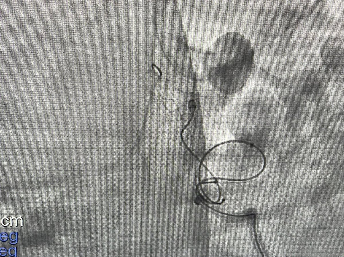 aswinforIR's tweet photo. Ruptured wide necked ACom Aneurysm causing SAH... BabyLeo assisted coiling...  #IRadKMCH https://t.co/yRrxIL2jmt