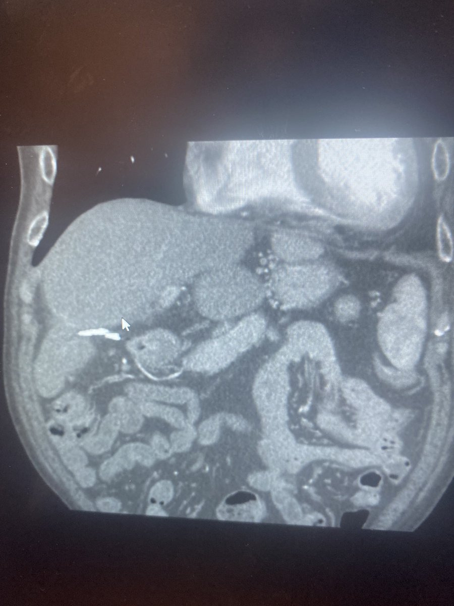 CharlesLugo007's tweet photo. Sub-diaphragmatic metastatic focus treated with IRE. @RajNarayanan67 @KutsenkoMD @SIRspecialists @drvarshana @MiamiVasc @BlakeJacks @StonyBrookMed @MiamiSpectrum  #oncology #IRE #Cancer https://t.co/1Dbm5eDHaz