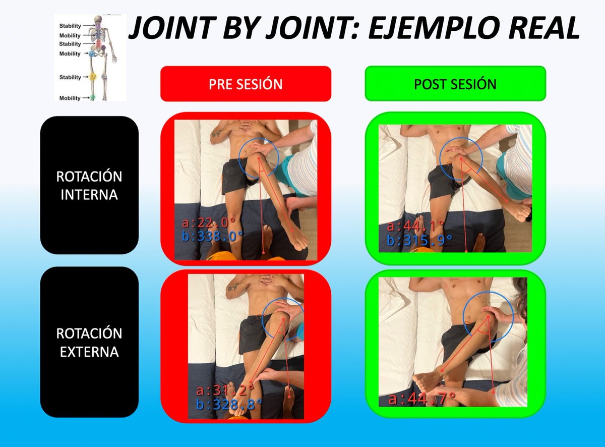 DavidSolleiro_'s tweet photo. 1/3 Gray Cook propone que existen articulaciones o grupos articulares móviles y estables.
La cadera debe ser una articulación móvil y un déficit en su movilidad puede generar dolor en la zona lumbar.

Caso real: 
Futbolista con dolor insidioso en zona lumbar. https://t.co/nxnxxVMmeQ