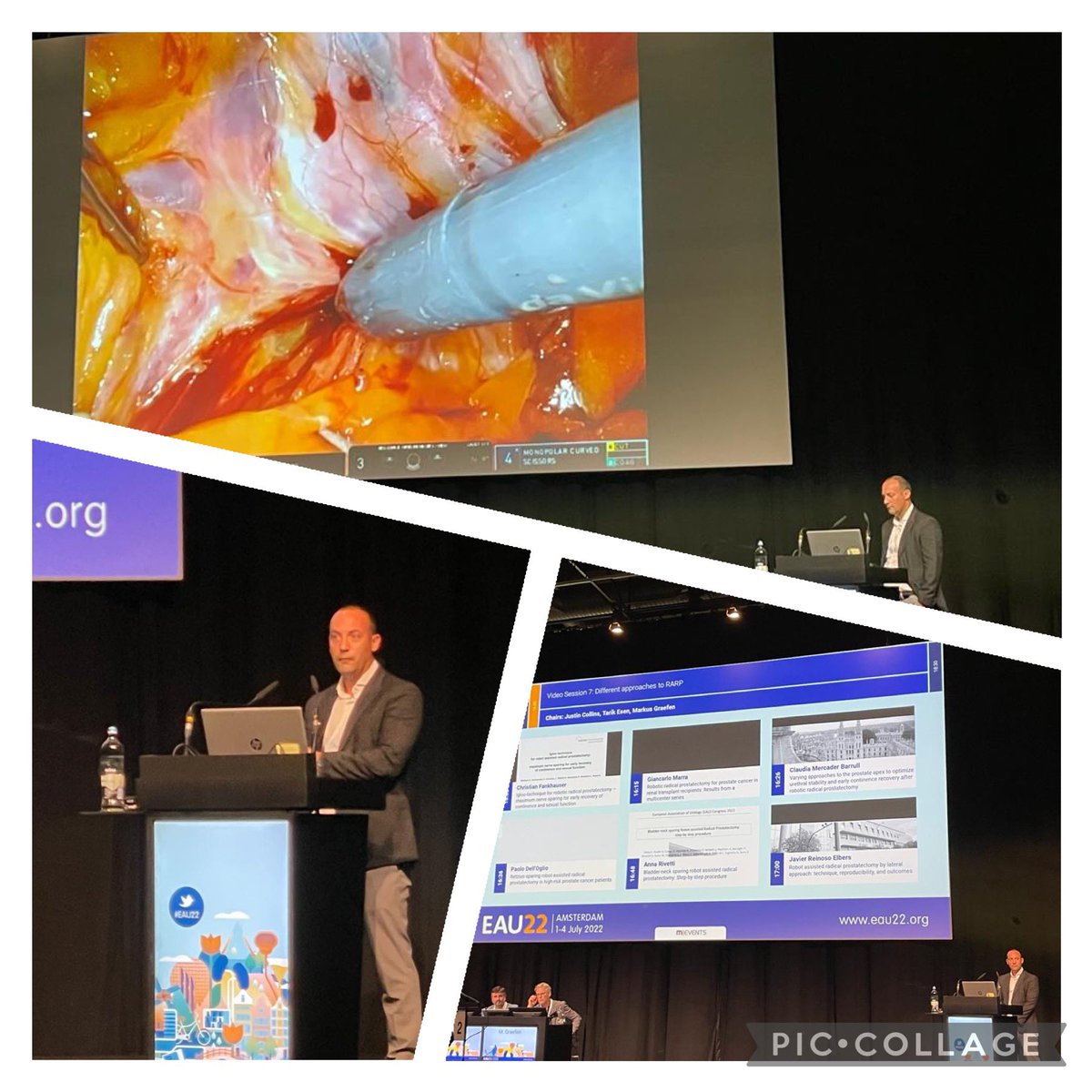 Sharing our experience in the reproducibility of the RARP by lateral approach(Richard Gaston technique ) at #EAU22 <a href="/ICUAurologia/">ICUA</a> <a href="/fgomsan/">Fernando GomezSancha</a> <a href="/ClinicaCEMTRO/">ClinicaCEMTRO</a> <a href="/moisessocarras/">Moises Socarras</a> <a href="/LuisLlanesGonz/">Luis Llanes</a> <a href="/JGomezRivas/">Juan Gómez Rivas</a> <a href="/diegocarrionm/">Diego M Carrión Monsalve</a> <a href="/Uroweb/">European Association of Urology (EAU)</a> <a href="/InfoAeu/">AEU</a> <a href="/ERUSrobotics/">ERUS Robotic Urology</a>