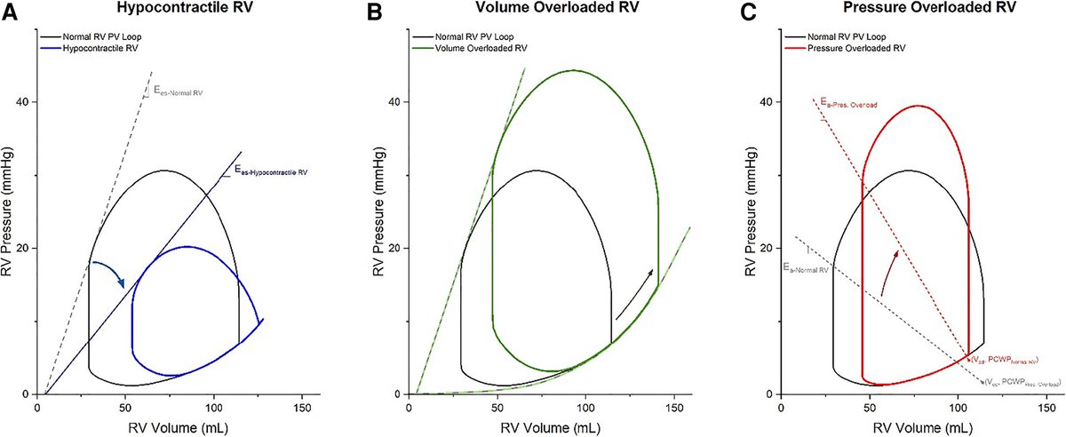 EHJACVCEiC's tweet photo. Epidemiology and management of right ventricular-predominant heart failure and shock in the CICU

-> fantastic, state of the art educational review in #EHJACVC @ESC_Journals by @manreetkanwar @NavinKapur4 et al. 

https://t.co/6iraNeRKPu https://t.co/uPYIlbyxcg