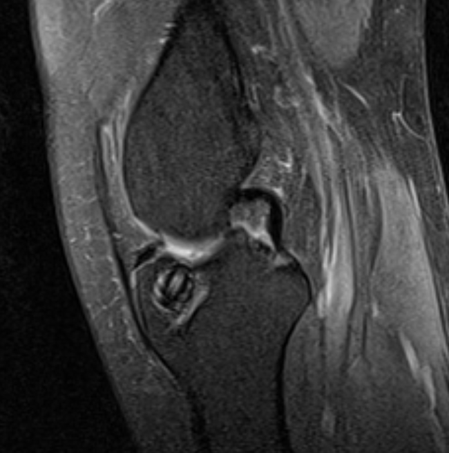 kneedoclond's tweet photo. 1/2.
ACL re-rupture in a knee that was never functionally stabilised following original HS based reconstruction.  AM knee pain on loading, tibial metaphysis......
#orthotwitter 
#ACLReconstruction
#RevisionACL https://t.co/Ns3tims7Tk