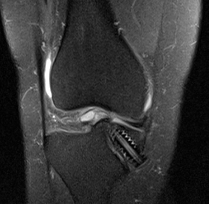 kneedoclond's tweet photo. 1/2.
ACL re-rupture in a knee that was never functionally stabilised following original HS based reconstruction.  AM knee pain on loading, tibial metaphysis......
#orthotwitter 
#ACLReconstruction
#RevisionACL https://t.co/Ns3tims7Tk
