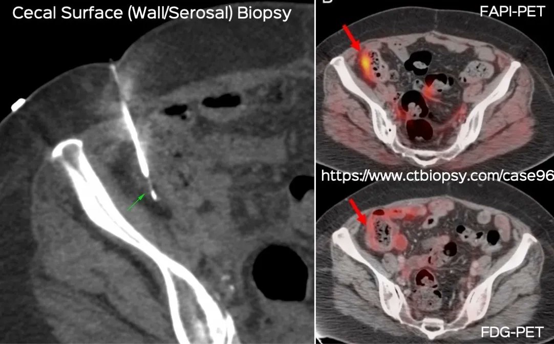 bhavinj's tweet photo. Case 96: Cecal Surface (Wall/Serosal) Biopsy
When the pre-bx imaging (in this case FAPI-PET) gives good information, the biopsy becomes easy
Post and video
https://t.co/jG2NrPggf1
#ctbiopsy #irrad #serosa #bowel #cecum #peritoneum #FAPIPET https://t.co/bW84jENXGW