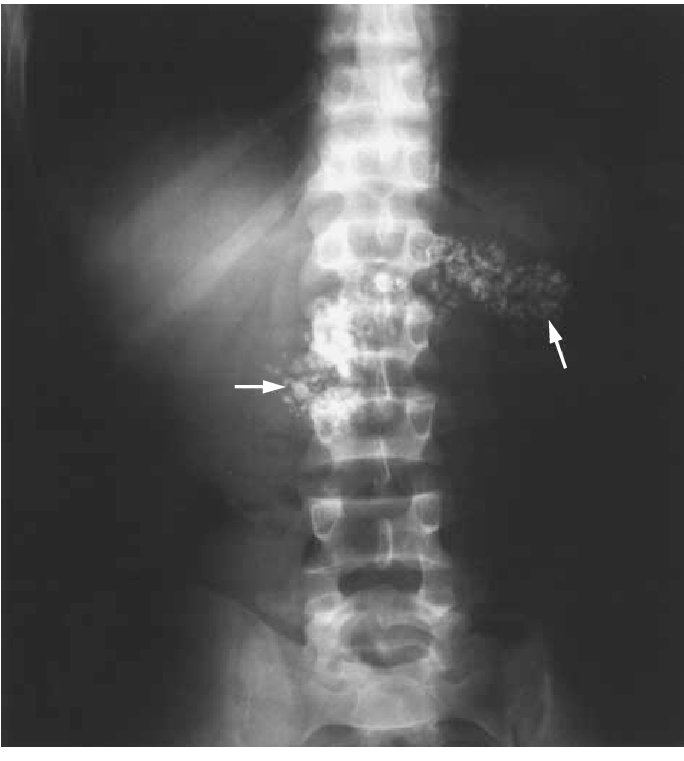 walinjom's tweet image. Epigastric pain + 
Malabsorbtion + 
Hypomagnesemia 
=  
Think Chronic Pancreatitis 

Med T3 
Creon (Pancreatic enzyme) + PPi 

#MedTwitter