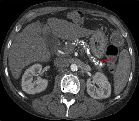 walinjom's tweet image. Epigastric pain + 
Malabsorbtion + 
Hypomagnesemia 
=  
Think Chronic Pancreatitis 

Med T3 
Creon (Pancreatic enzyme) + PPi 

#MedTwitter