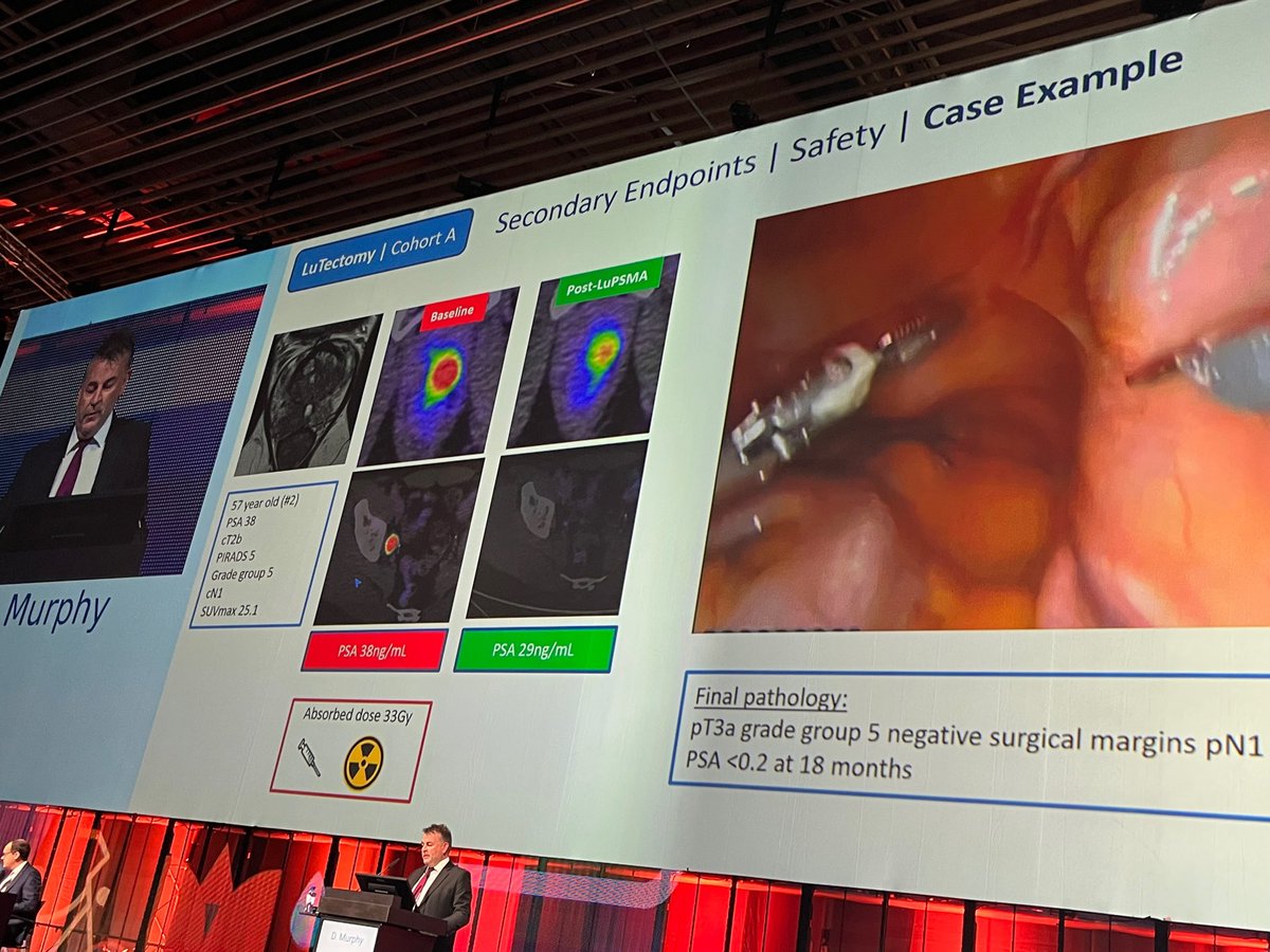 European Association of Urology (EAU) (@uroweb) on Twitter photo Game Changer 3 at #eau22 – This morning <a href="/declangmurphy/">Declan Murphy</a> shared encouraging initial trial results for LuTectomy. Neoadjuvant Lu-PSMA is safe, effective and surgery is very straight forward. Game Changer 3 at #eau22 – This morning <a href="/declangmurphy/">Declan Murphy</a> shared encouraging initial trial results for LuTectomy. Neoadjuvant Lu-PSMA is safe, effective and surgery is very straight forward.