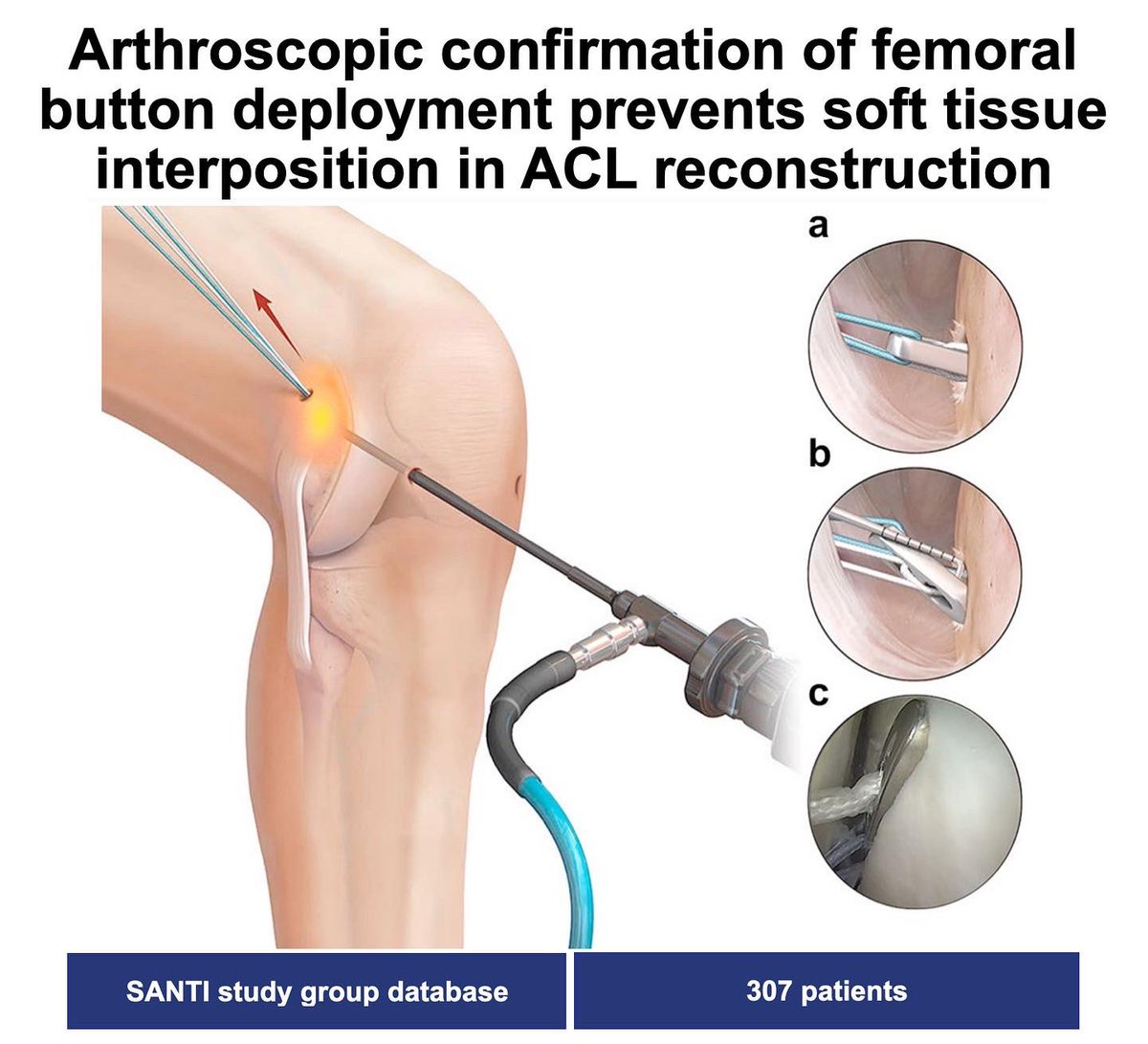 KSSTA's tweet photo. Intra-articular positioning of the femoral tunnel exit point in ACL reconstruction allows arthroscopic control of the femoral button, preventing improper deployment and soft tissue interposition

#sportsmedicine #sportsinjury #arthroscopy

Link: https://t.co/YSFrqFHUsm https://t.co/sORgnk1xiz