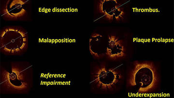 PCRonline's tweet photo. Understand how to use intravascular ⭕️ imaging to analyse the reasons for stent failure (restenosis and/or thrombosis) by viewing these 2 cases shared by your peers 😷: 1 focusing on OCT &amp; the other on IVUS 
https://t.co/G4YsNyWAc2 #cardioed 
(access via your free My PCR account) https://t.co/50OrXDuWiA