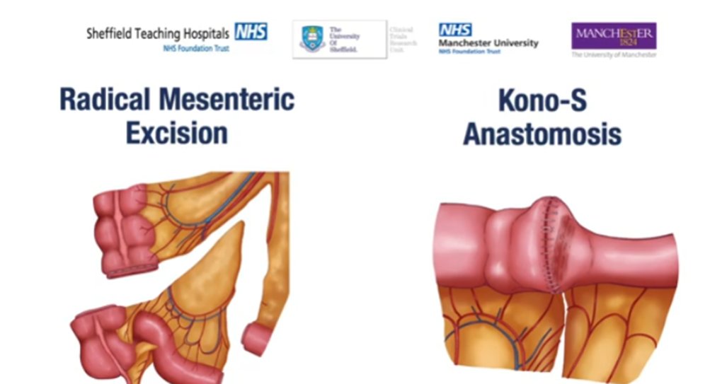 Want decreased rates 😇of anastomotic recurrence in Crohn's?

🧐 at 🔥🔥 freely accessible 🎬📽️on steps to perform 👇👇

✂️Standardised radical mesenteric excision
 
✂️Kono-S Anastomosis 

#SoMe4Surgery #TraineeTips

Link - doi.org/10.1007/s10151…