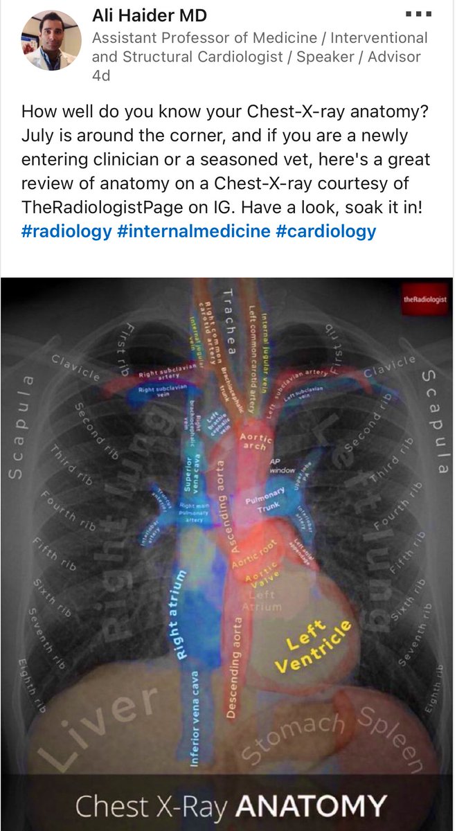 Thank you Dr. Haider for posting this image. In a world of multimodality imaging we often overlook the original king - CXR.