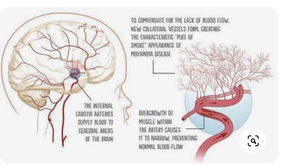OGdukeneurosurg's tweet photo. A short but solid primer to know about on moyamoya disease. https://t.co/yemNA4D5xs