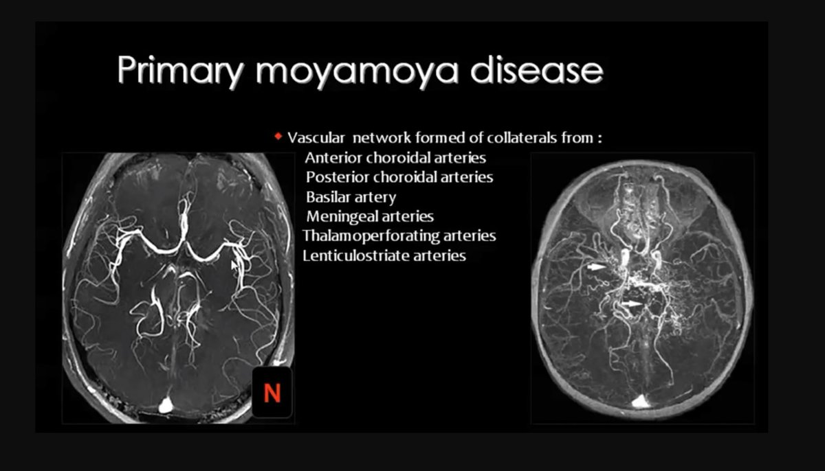 OGdukeneurosurg's tweet photo. A short but solid primer to know about on moyamoya disease. https://t.co/yemNA4D5xs