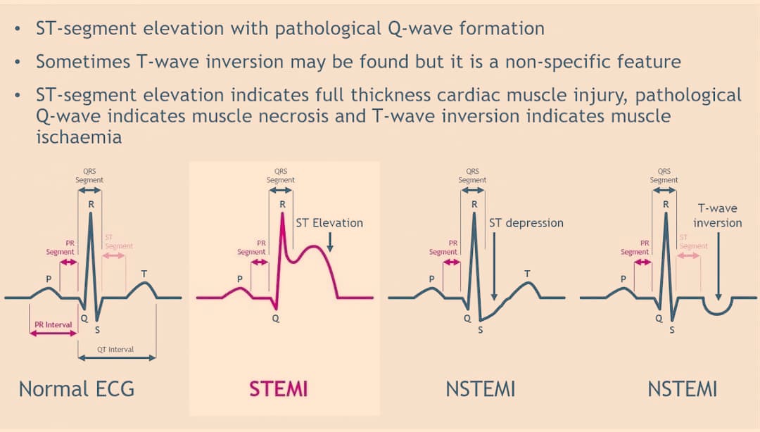 HouseofmedicalK's tweet photo. #NormalECG #STEMI #NSTEMI https://t.co/Ym4bXiV1cE