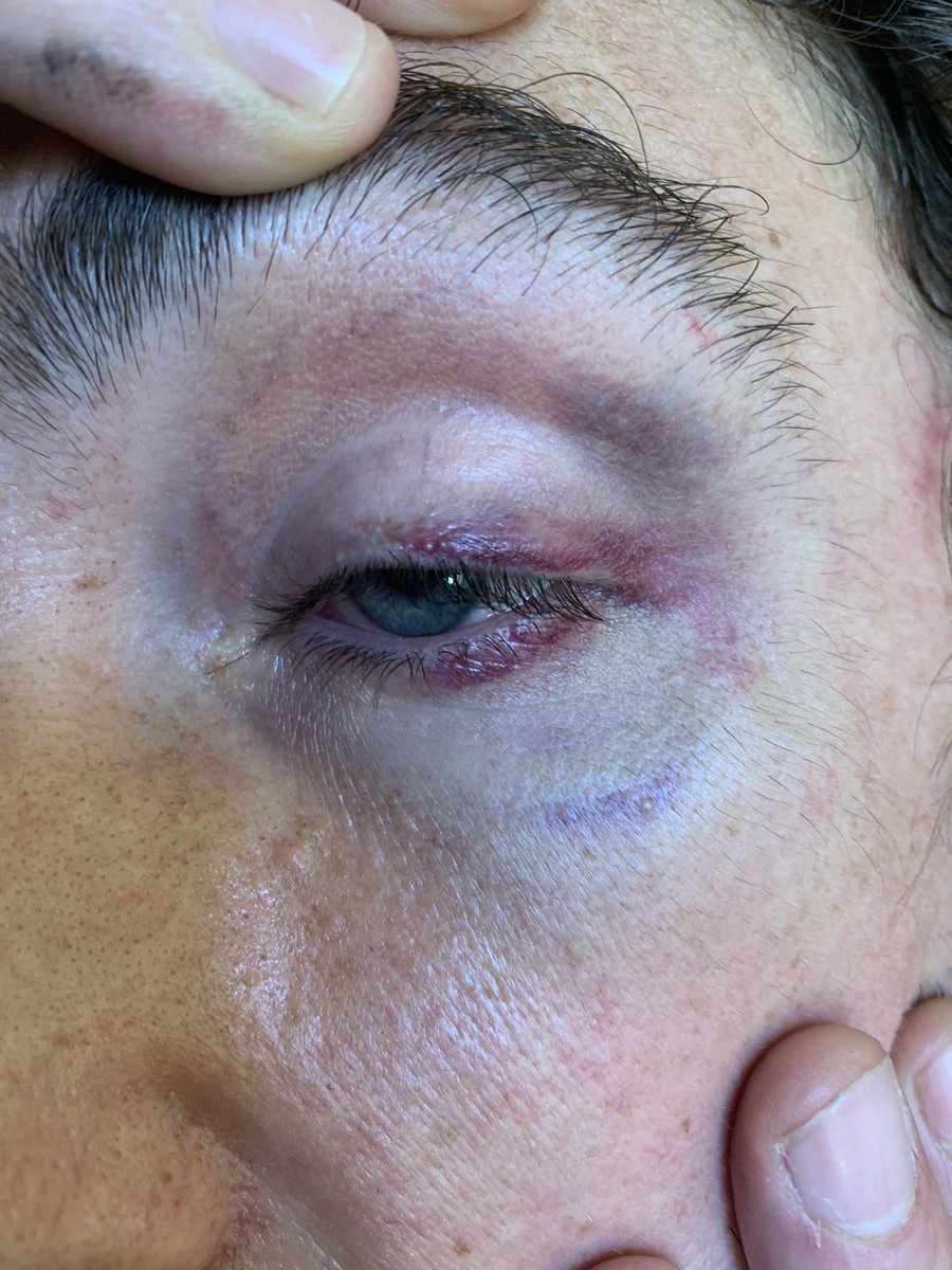 chuli_paquin's tweet image. RACCONTO UNA VIOLENTA AGGRESSIONE SUBITA IERI SERA A #PARMA 1/ Ieri notte io e @_R__ stavamo tornando a casa con i cani. In piazzale san Lorenzo, in una macchina con luce accesa in mezzo alla strada, due ragazzi facevano uso di cocaina. Non sappiamo cosa sia successo,