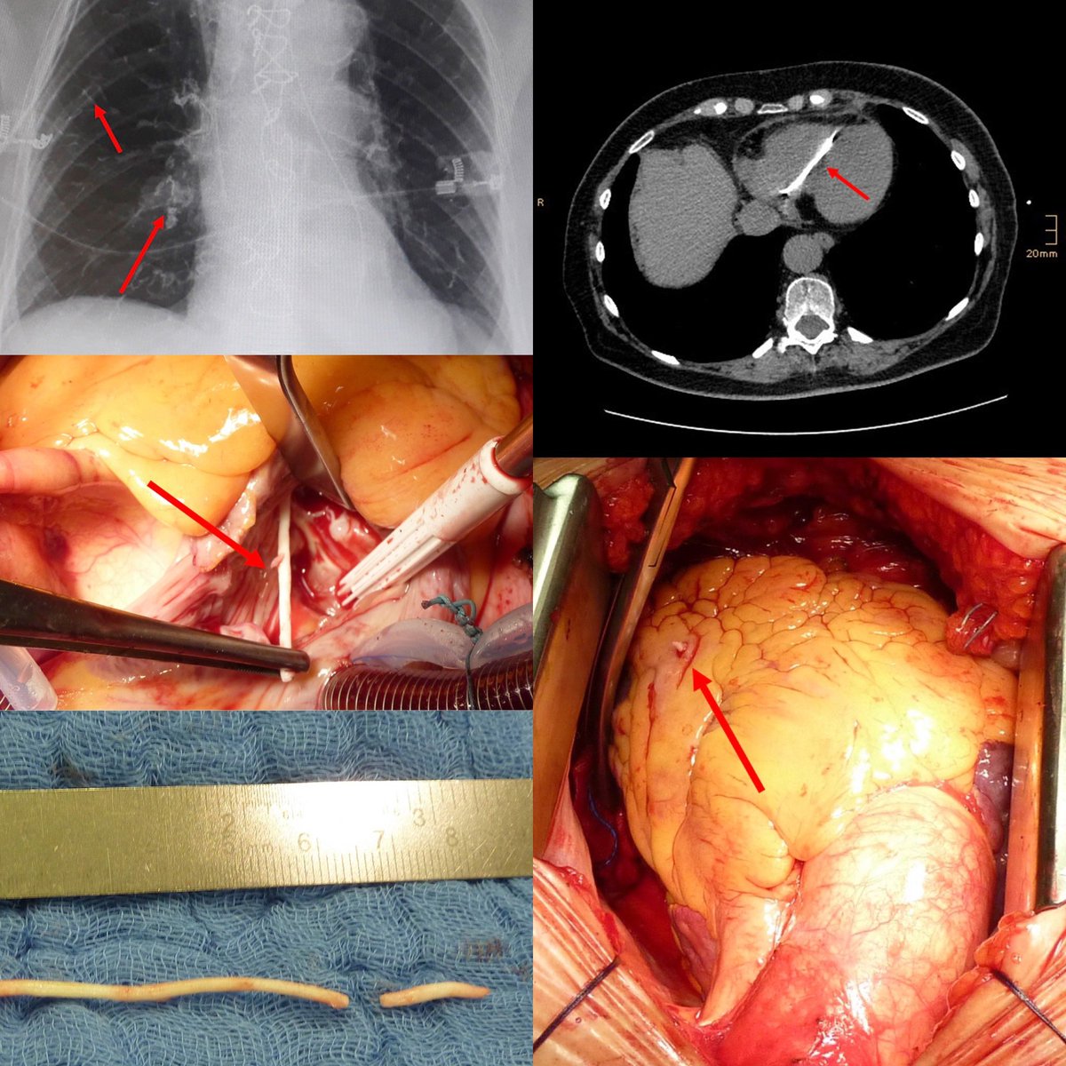 JGrapsa's tweet image. #jacccasereports #complications Kyphoplasty ➡️ extravasation of cement to venous system ➡️ RV perforation ➡️ increasing SOBOE ➡️ jacc.org/doi/10.1016/j.… @JACCJournals @mividovich @fischman_david @EstefaniaOS @echo_stepbystep @BakhshiHooman @ACCinTouch @gina_lundberg