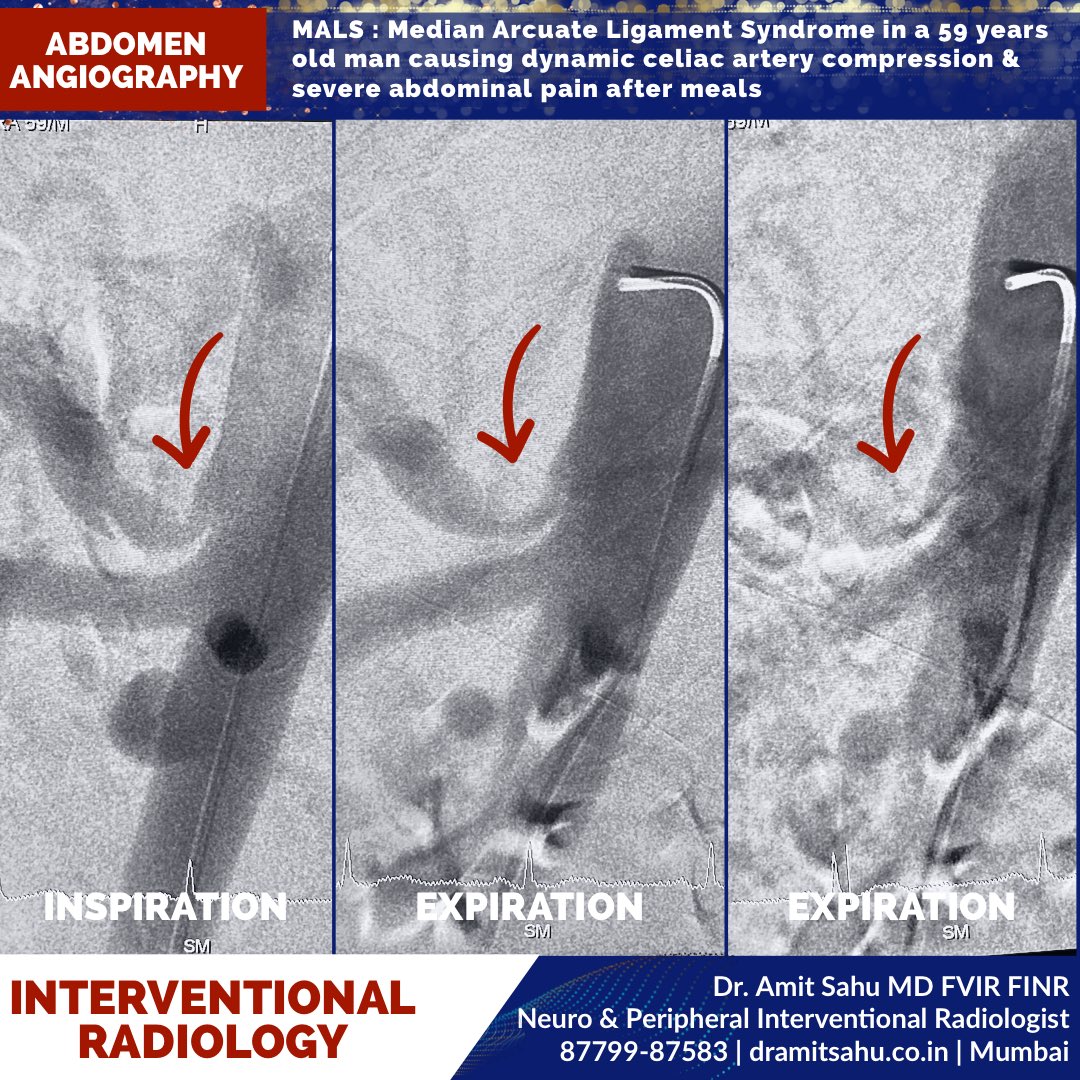 Dr. Amit Sahu MD FVIR FINR tweet media