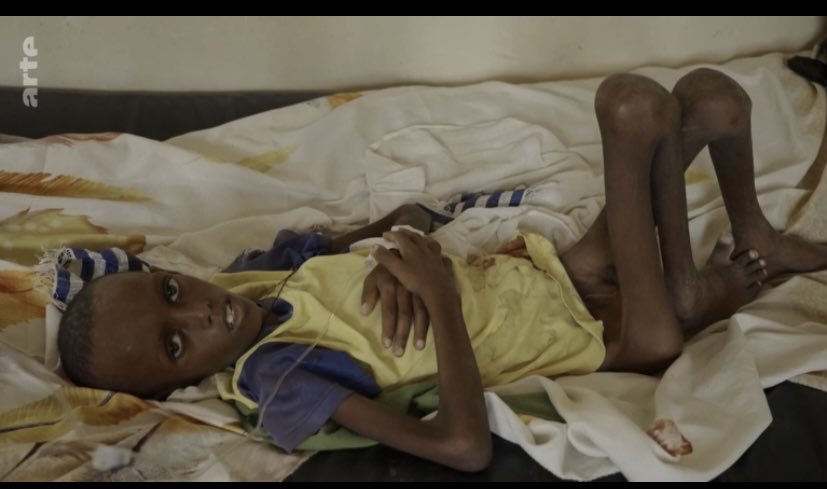 adecort's tweet photo. Dr Tesfaye in a rural hospital in Tigray: “We cannot give him any further treatment. He is eleven years old and eight kilograms [17.6 pounds], which is not [he begins to cry and can’t finish speaking].” Gov-supervised famine happening right now in Ethiopia. Raise your voice! https://t.co/kYpzb1DVt2