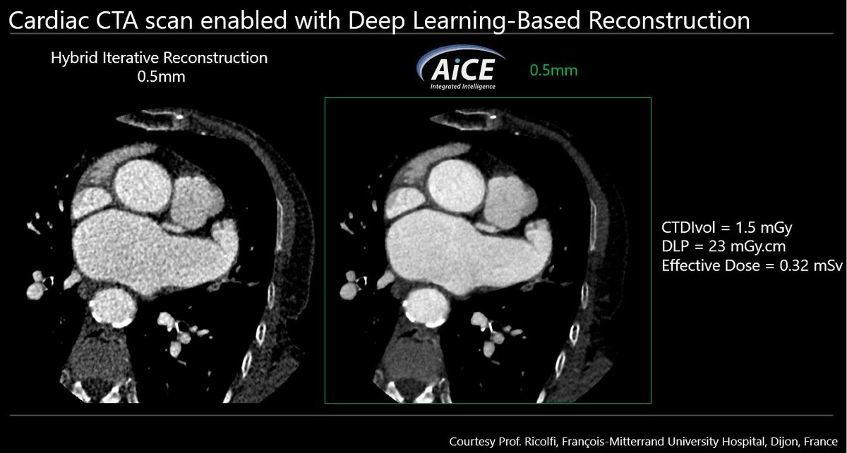 CanonMedicalANZ's tweet image. Interested to learn how #DeepLearningReconstruction algorithms, powered by Altivity, can reduce radiation dose and improve image quality in #CT #angiography? 

Visit  bit.ly/3NUgRAt

Courtesy Prof. Ricolfi, François-Mitterrand University Hospital, Dijon, France