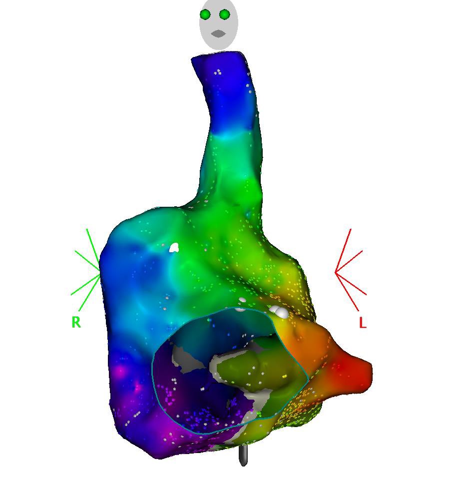 CTI block mapping : sometimes simple is the nicest ! <a href="/CHURennes/">CHU de Rennes</a> #EPeeps