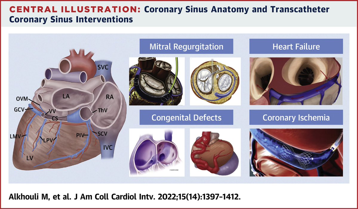 Our SOA on transcatheter coronary sinus interventions is now online. The 📝 covers key aspects of CS anatomy, techniques & evolving data on CS-based interventions for coronary ischemic, MR, HF & congenital defects. jacc.org/doi/10.1016/j.…