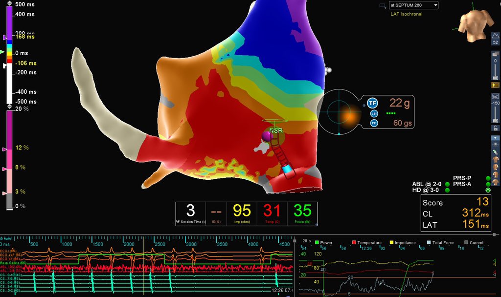 Post MAZE c. 2014 pt presented in aAFL. LA aAFL and ABL resulted in RA aAFL and ABL. Extremely impressive “full CL-esque” signals in both LA and RA on #HDG. RA septal ABL terminated arrhythmia after LA aAFL and RA aAFL ABL. 200k+ pts collected in total. Strong work by <a href="/JonHsuMD/">Jonathan Hsu, MD</a>