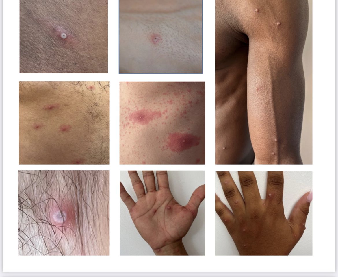 #monkeypox 
Transmission par contact sexuel mais pas que.
Hommes-Femmes-non genrés
Lésions cutanées très diverses.
Plusieurs poussées possible.
Atteinte de tout le corps possible.
<a href="/SPILF_/">SPILF</a> <a href="/ReJIF_/">RéJIF</a> <a href="/charles_cazanav/">Charles.Cazanave</a> <a href="/sfls_vih/">SFLS</a> <a href="/SFDermatologie/">Société Française de Dermatologie</a> <a href="/assoAIDES/">Association AIDES</a> <a href="/actupparis/">Act Up-Paris</a>
<a href="/JZeggagh/">jeremy zeggagh</a>