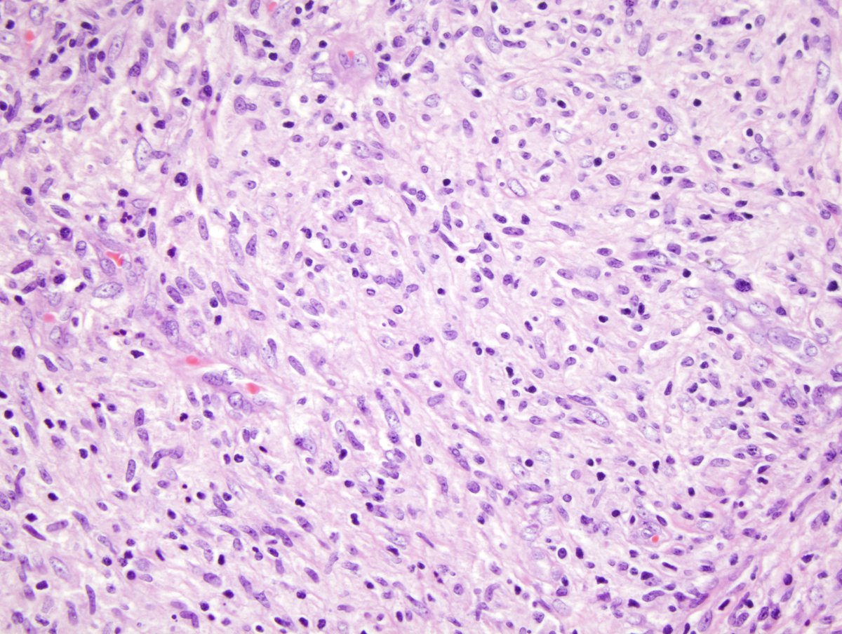 #hemepath #IDpath mycobacterial spindle cell tumor