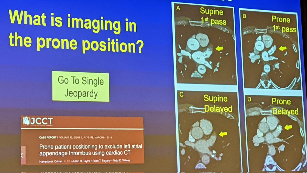 Renée Bullock-Palmer MD FACC FAHA FASNC FASE FSCCT (@rbp0612) on Twitter photo Imaging in the prone position can help to exclude LAA clot. <a href="/Heart_SCCT/">Heart_SCCT</a> #SCCT2022 <a href="/AChoiHeart/">Dr Andrew D. Choi</a> <a href="/purviparwani/">Dr. Purvi Parwani</a> <a href="/PatrycjaGalazka/">Patrycja Galazka</a> <a href="/iamritu/">Ritu Thamman MD</a> <a href="/ghoshhajra/">Brian with the Good Dictations</a> <a href="/Nidhi_Madan9/">Nidhi Madan, MD, MPH</a> <a href="/SinghVasvi/">Vasvi Singh</a> <a href="/Kfarooqi/">Dr. Kanwal M Farooqi</a> <a href="/anjali_chelliah/">Anjali Chelliah</a> Imaging in the prone position can help to exclude LAA clot. <a href="/Heart_SCCT/">Heart_SCCT</a> #SCCT2022 <a href="/AChoiHeart/">Dr Andrew D. Choi</a> <a href="/purviparwani/">Dr. Purvi Parwani</a> <a href="/PatrycjaGalazka/">Patrycja Galazka</a> <a href="/iamritu/">Ritu Thamman MD</a> <a href="/ghoshhajra/">Brian with the Good Dictations</a> <a href="/Nidhi_Madan9/">Nidhi Madan, MD, MPH</a> <a href="/SinghVasvi/">Vasvi Singh</a> <a href="/Kfarooqi/">Dr. Kanwal M Farooqi</a> <a href="/anjali_chelliah/">Anjali Chelliah</a>