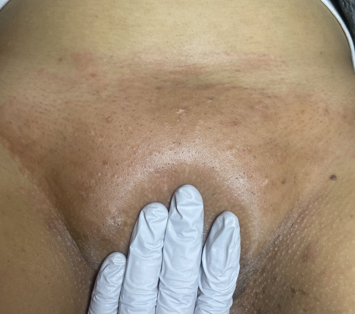 HoodSthetics's tweet photo. Hey Twitter 

I’m an Esthetician located in Dallas ( Oakcliff ) 

I am currently holding a Wax special 
✨50%  off ✨ 

You don’t want to miss out 🤗

Dm to book 💜 

Ig : Hood.Sthetics 

*final price shown below https://t.co/mrnJLR5Czu