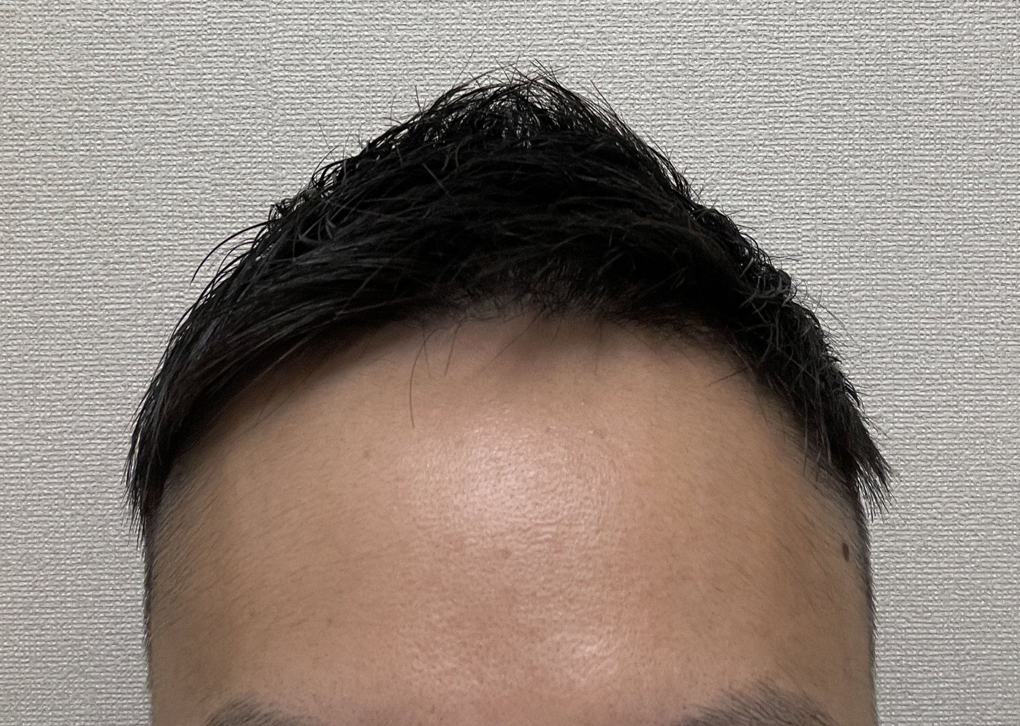 みや Aga治療 メンズ美容 Hagemiyachan Twitter