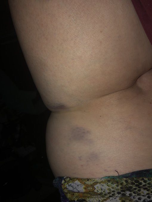 I fell hard the other night. These hurt :( https://t.co/E7uPKEJogB<a href="/tag/realloyalfans"class="tags"><span>#realloyalfans</span></a>