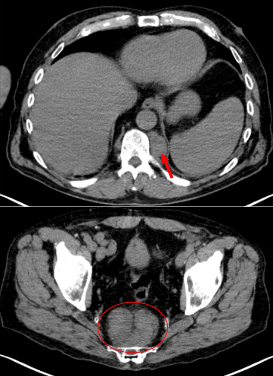 J_Hematology's tweet photo. Non-Hepatosplenic #Extramedullary #Hematopoiesis Masquerading as Metastatic Malignant #Melanoma https://t.co/JAM9VSN9Rr https://t.co/scuOz1VSgk