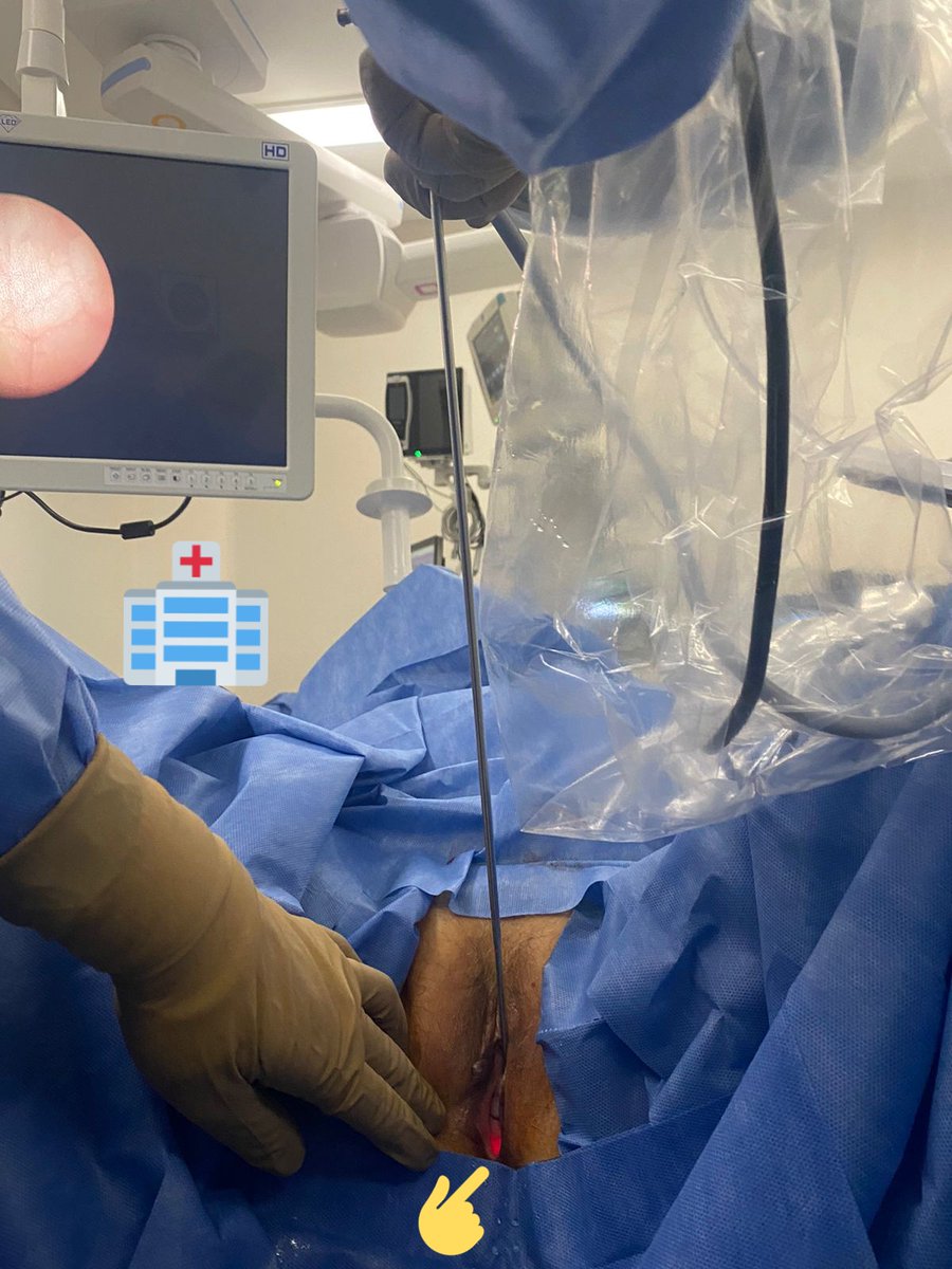 Diego Santillan (@diesantillan) on Twitter photo #endourology #urotips
📝 In prolapsed bladders, the entrance to the ureteral meatus often involves verticalizing the ureteroscope❗
<a href="/MSGONZALEZURO/">Mariano Sebastian Gonzalez</a> <a href="/sbinhamrii/">Saeed Bin Hamri</a> <a href="/migokce/">Mehmet Ilker Gökce</a> <a href="/VicentiniUro/">Fabio Vicentini 🇧🇷</a> <a href="/PabloNContreras/">Pablo Contreras</a> <a href="/DocGauhar/">DrG</a>
<a href="/CristalloCh/">Christian Cristallo</a> <a href="/A_CabreraURO/">Andres Cabrera</a>
<a href="/georgeabril/">Jorge Abril</a> <a href="/FrancoThomasOK/">Franco Thomas</a> #endourology #urotips
📝 In prolapsed bladders, the entrance to the ureteral meatus often involves verticalizing the ureteroscope❗
<a href="/MSGONZALEZURO/">Mariano Sebastian Gonzalez</a> <a href="/sbinhamrii/">Saeed Bin Hamri</a> <a href="/migokce/">Mehmet Ilker Gökce</a> <a href="/VicentiniUro/">Fabio Vicentini 🇧🇷</a> <a href="/PabloNContreras/">Pablo Contreras</a> <a href="/DocGauhar/">DrG</a>
<a href="/CristalloCh/">Christian Cristallo</a> <a href="/A_CabreraURO/">Andres Cabrera</a>
<a href="/georgeabril/">Jorge Abril</a> <a href="/FrancoThomasOK/">Franco Thomas</a>